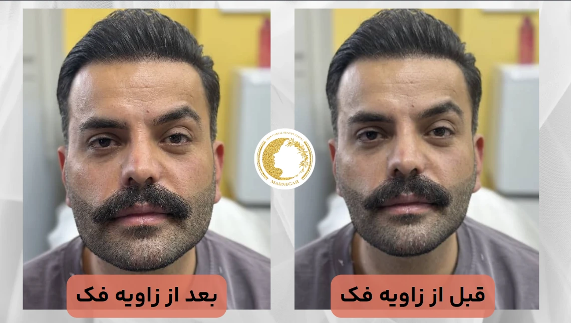 زاویه سازی فک