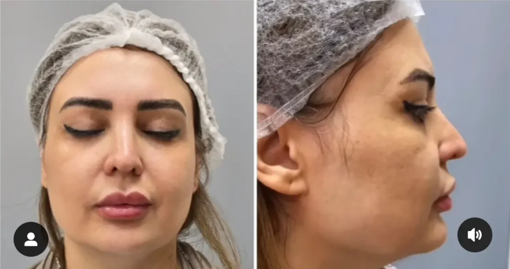 هایفوتراپی صورت تصویر بعد