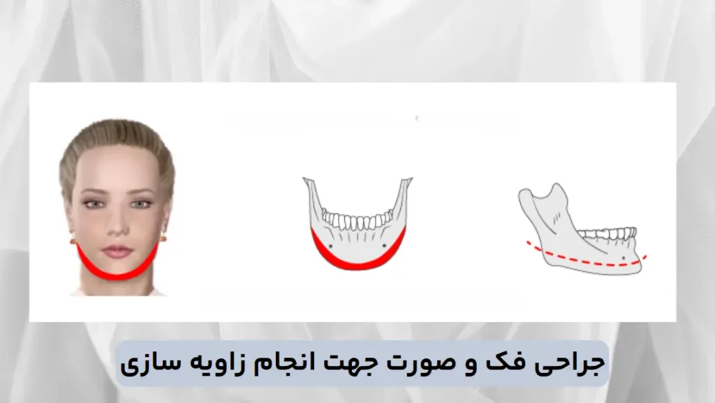 جراحی فک و صورت جهت انجام زاویه سازی