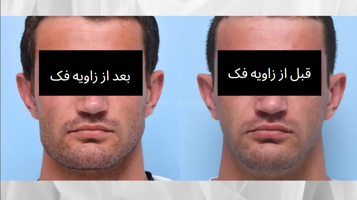 زاویه-سازی-فک-در-تهران