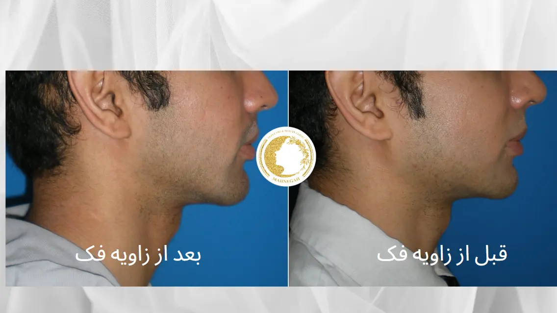 زاویه-فک-برای-آقایان