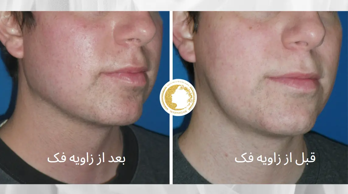 عکس-قبل-و-بعد-زاویه-فک