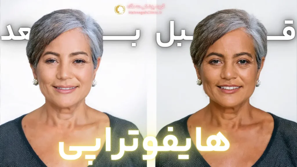 آیا هایفوتراپی صورت را لاغر می‌کند؟