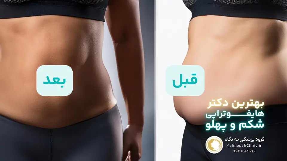 تصویر قبل و بعد هایفوتراپی شکم
