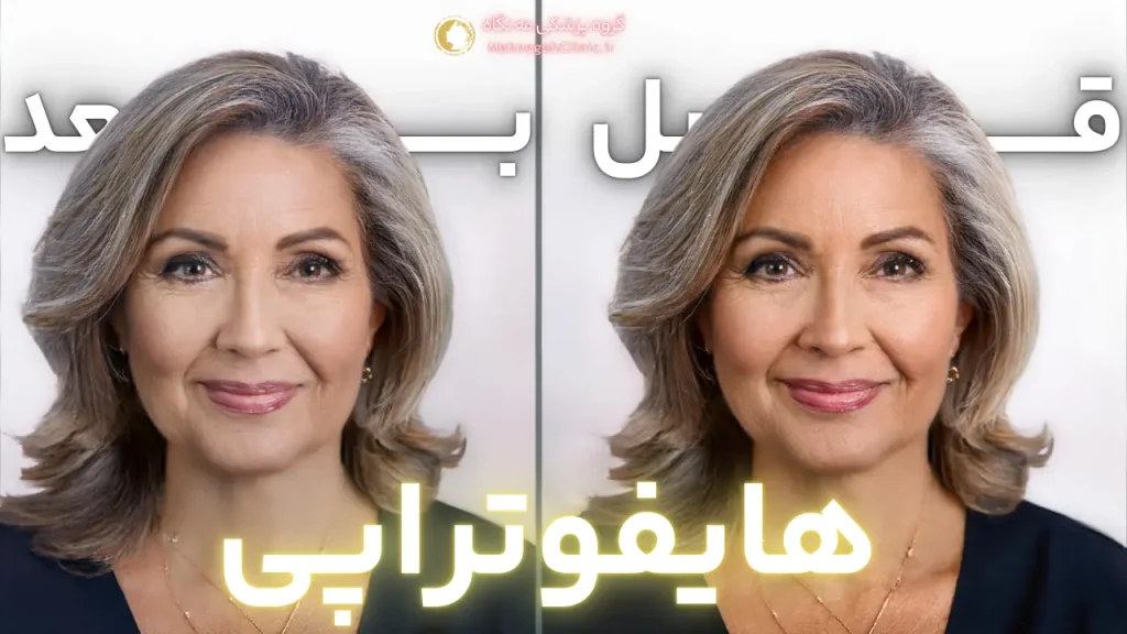 عوارض هایفوتراپی صورت در سعادت آباد