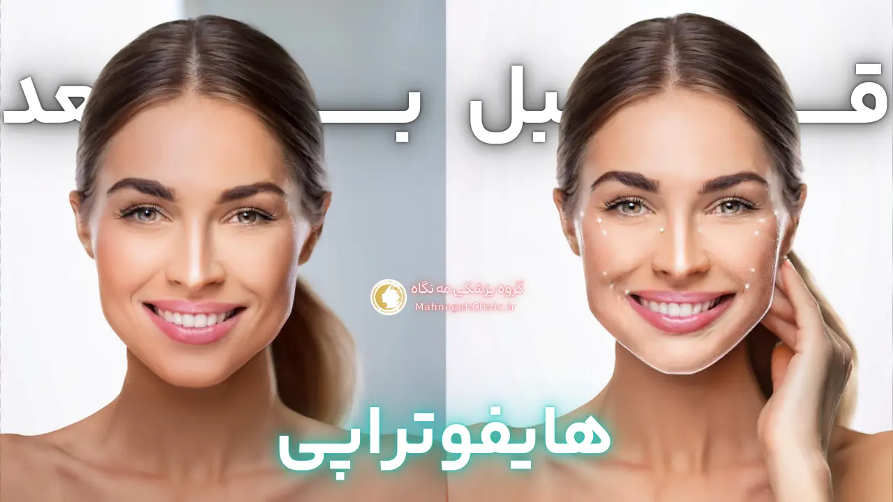 عکس قبل و بعد از هایفوتراپی در سعادت آباد تهران