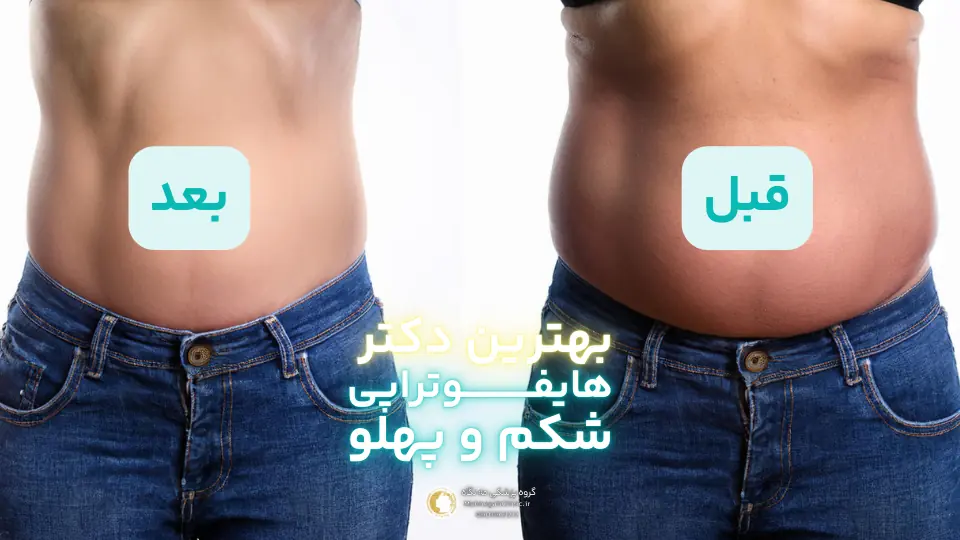 عکس قبل و بعد هایفو شکم