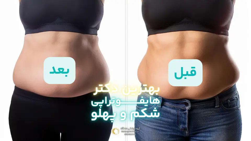 عکس قبل و بعد هایفوتراپی شکم و پهلو توسط بهترین دکتر هایفوتراپی شکم در سعادت آباد