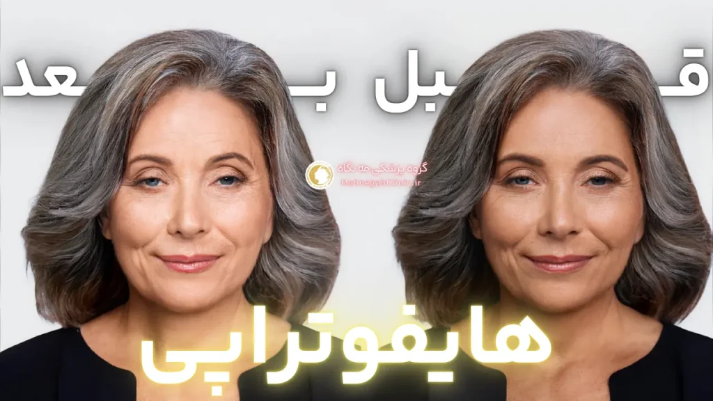 قیمت هایفوتراپی صورت در سعادت آباد