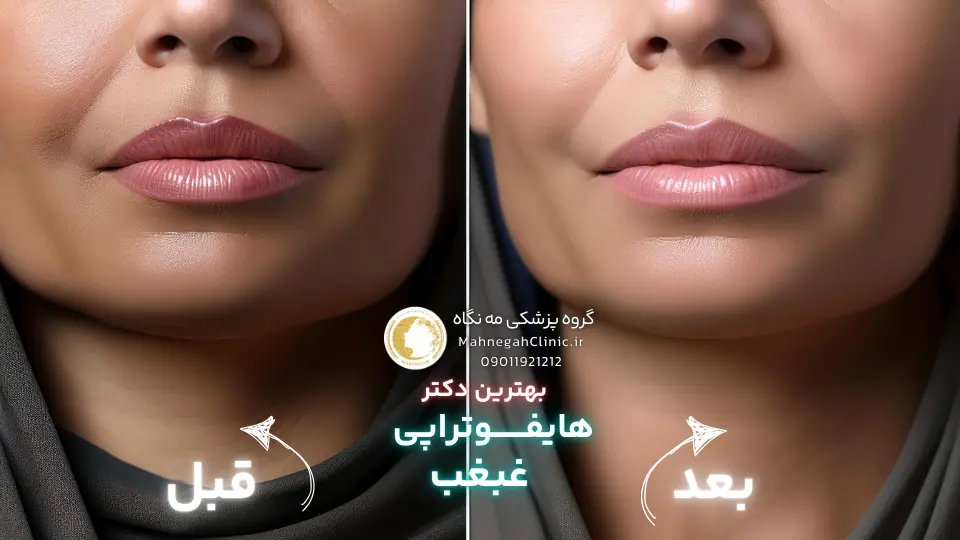 مزایای هایفوتراپی غبغب نسبت به سایر روش_ها