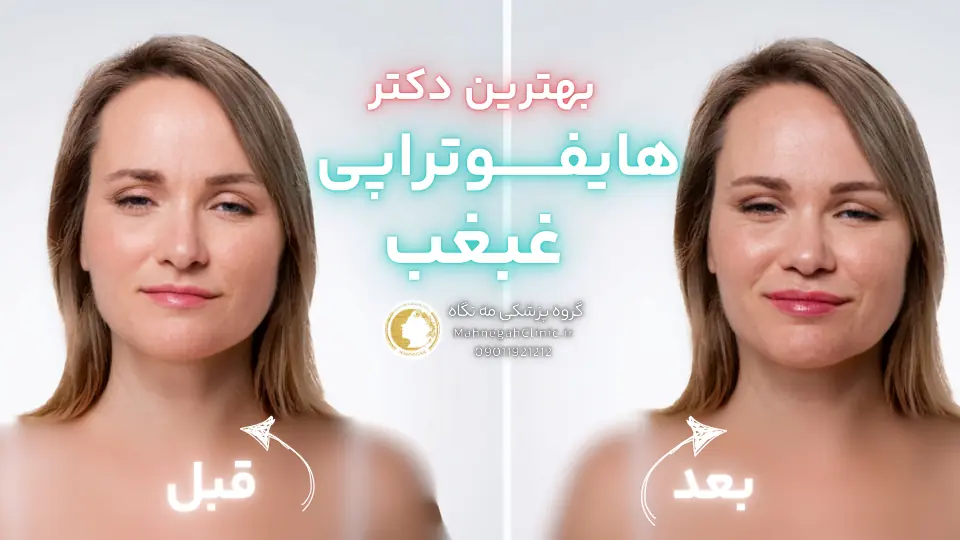 معیارهای انتخاب بهترین دکتر هایفوتراپی غبغب در سعادت آباد