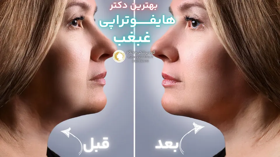 هایفوتراپی غبغب چیست و چگونه عمل می_کند؟
