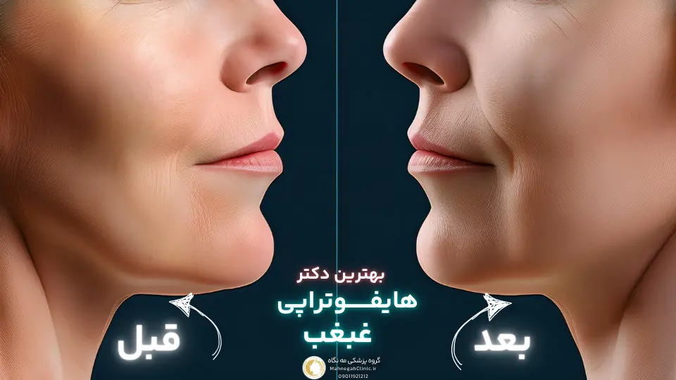 ویژگی_های بهترین دکتر هایفوتراپی غبغب در سعادت آباد